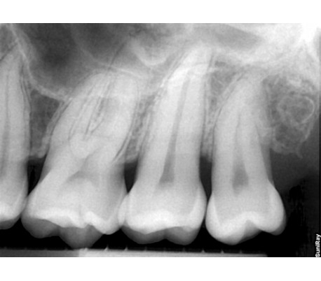 Suni - SuniRay2 Digital X-Ray Sensor