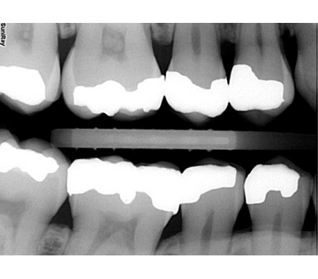 Suni - SuniRay2 Digital X-Ray Sensor