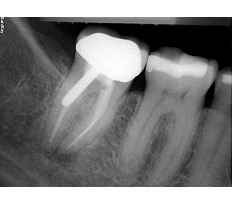 Suni - SuniRay2 Digital X-Ray Sensor