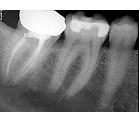 Suni - SuniRay2 Digital X-Ray Sensor