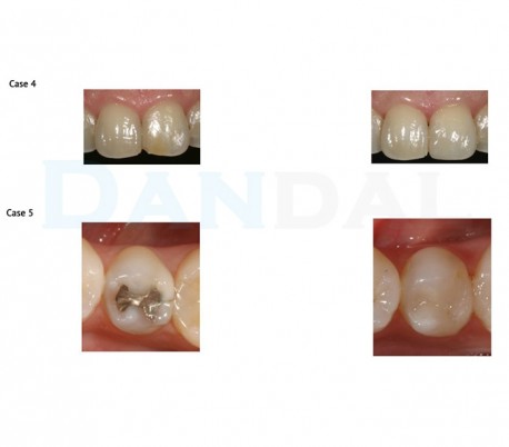 GC - Kalore Universal Composite