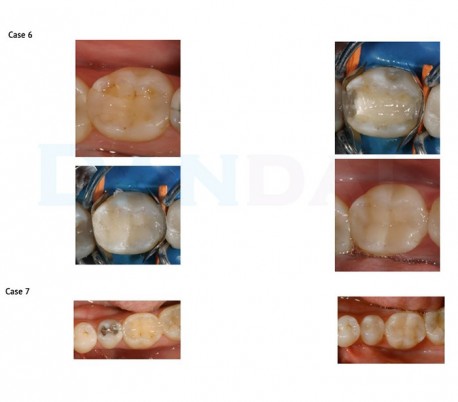 GC - Kalore Universal Composite