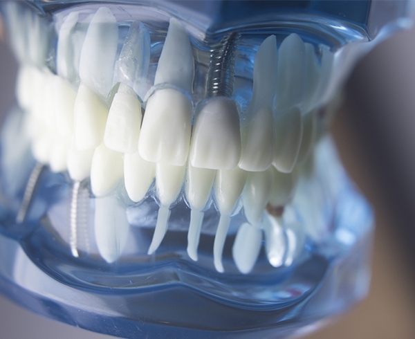 ابزار دندانپزشکی و ابزار لازم برای جراحی و کاشت ایمپلنت دندانی - دندال