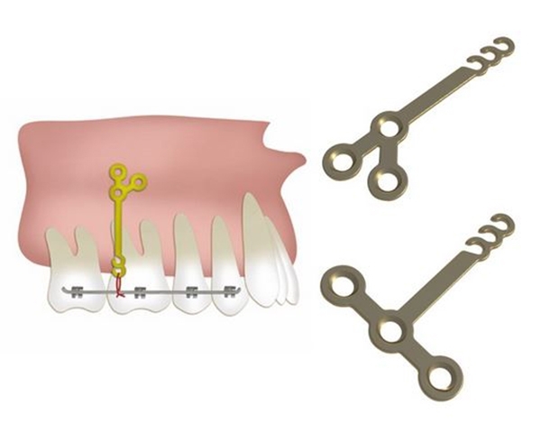 جراحی ارتودنسی و سیستم Dual Top | ابزار دندانپزشکی دندال
