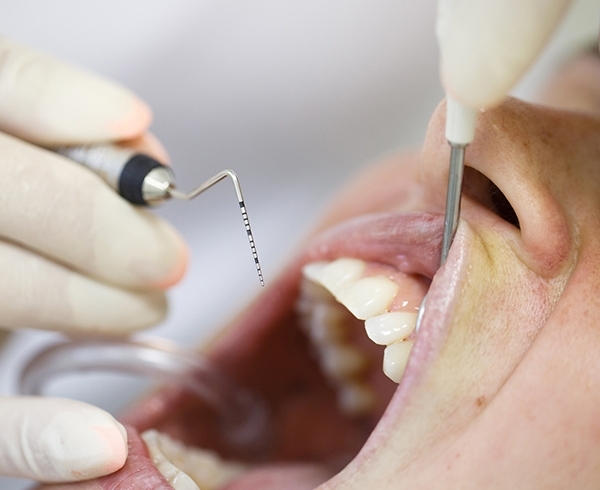 ابزار پریو و جراحی دندانپزشکی - دندال