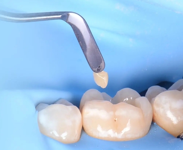 ابزار ترمیمی و اپراتوری دندانپزشکی - دندال
