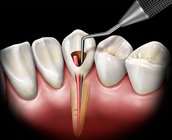 Endodontic Instruments & Endodontic Microsurgical Instruments - Dandal