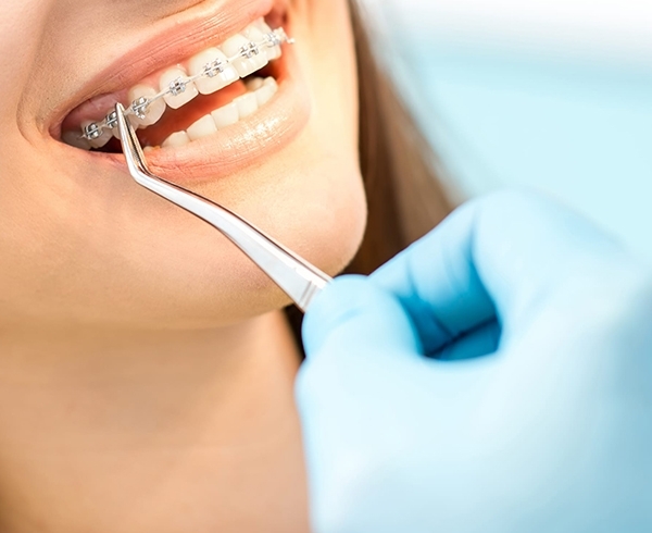 انواع مختلف ابزار ارتودنسی دندانپزشکی - دندال