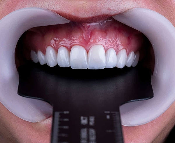 ابزار دنتال فتوگرافی و عکاسی دندانپزشکی - دندال
