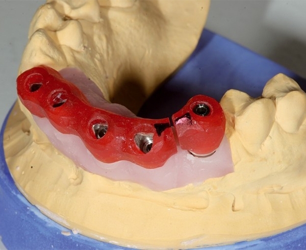آکریل ترمیم پروتزهای دندانی و الگوبرداری (پترن رزین)