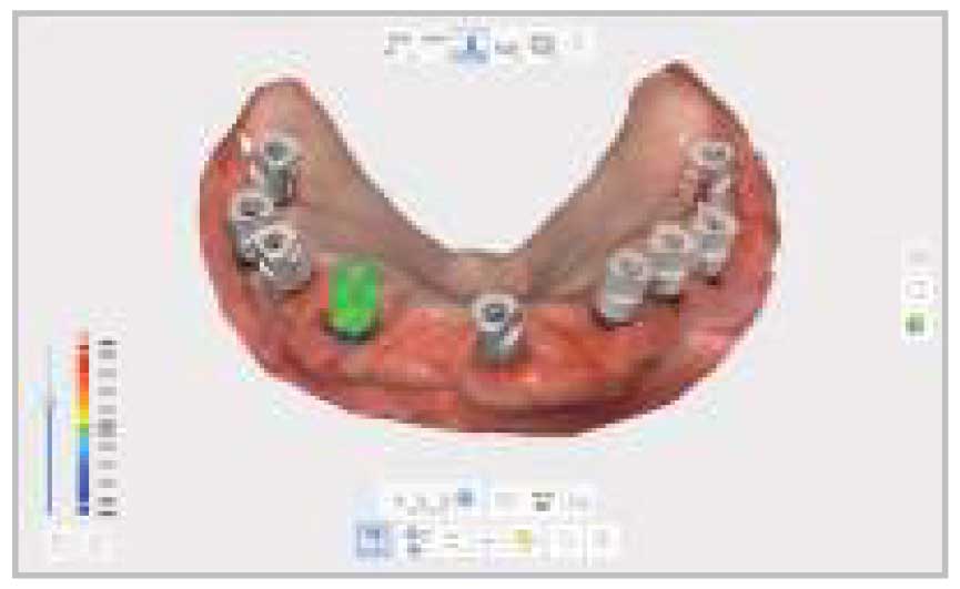 Medit - i700 Intraoral Scanner