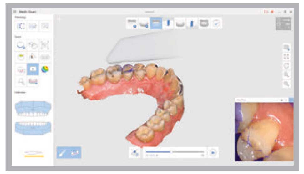 Medit - i500 Intraoral Scanner