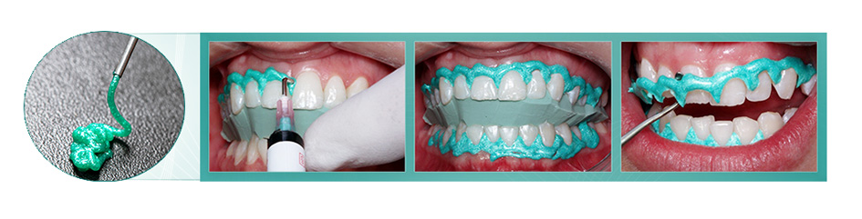 BIODINAMICA- BIODAM- LIGHT CURE GINGIVAL BARRIER