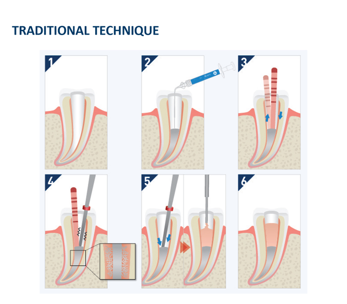 Dia-Root Bio Sealer Procedure 1