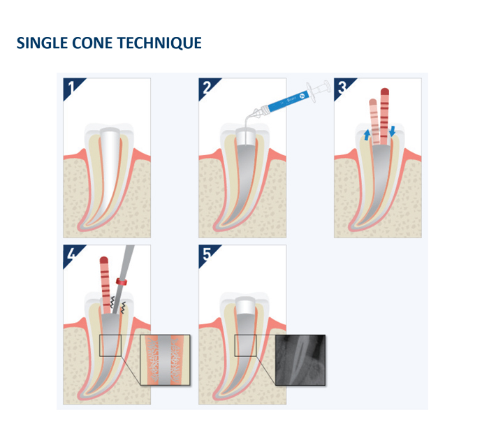 Dia-Root Bio Sealer Procedure 2