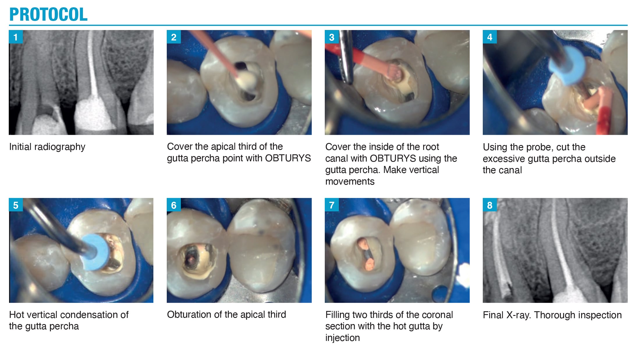 itena Obturys protocol