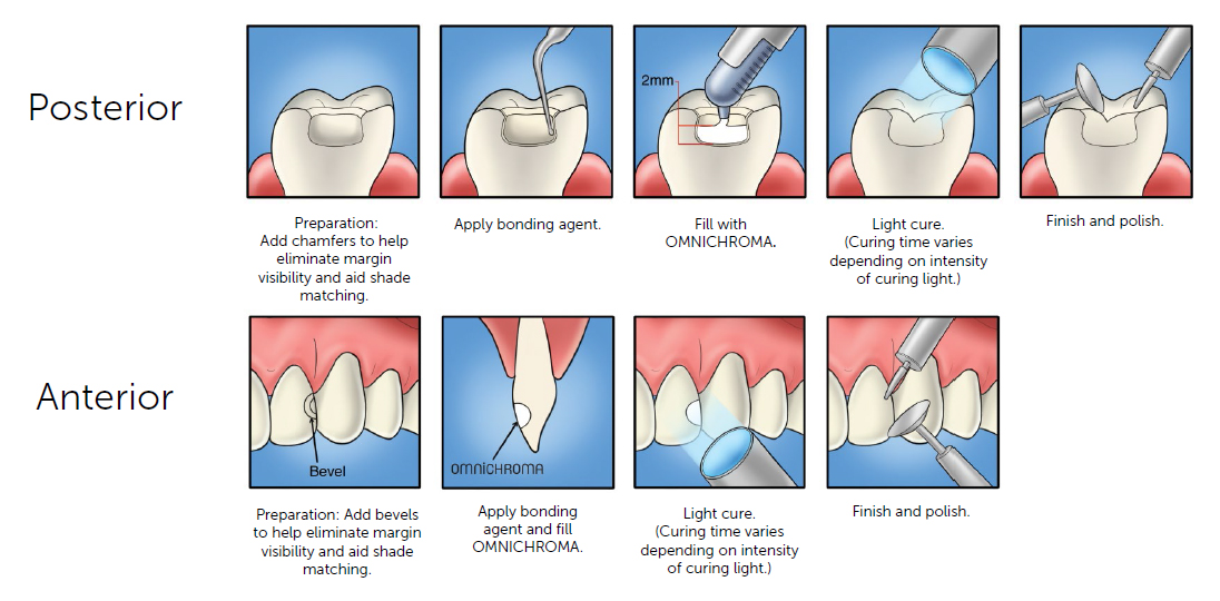  Tokuyama OmniChroma procedure1