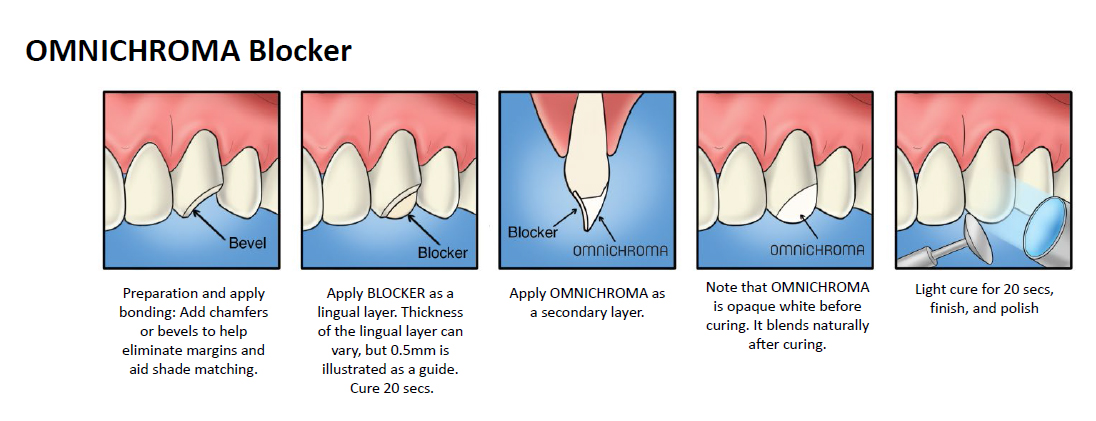  Tokuyama OmniChroma blocker procedure