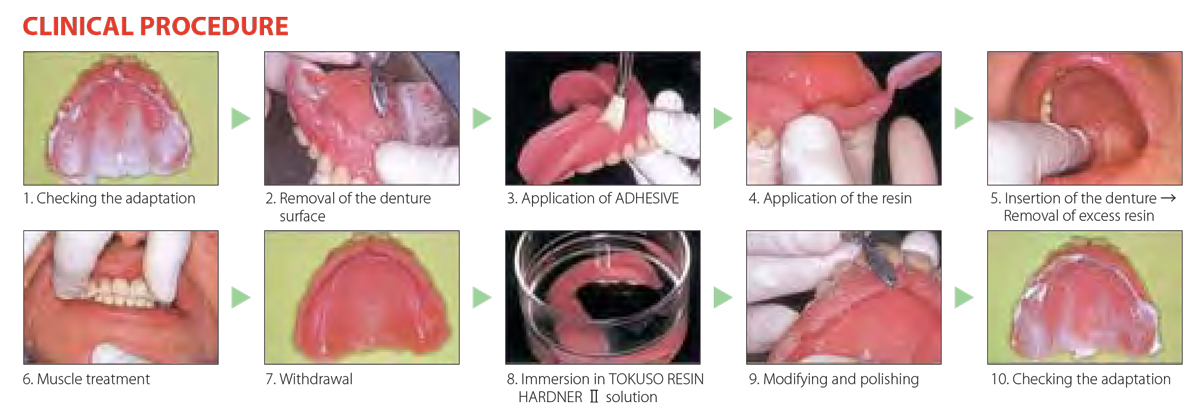 Tokuyama - Rebase II clinical procedure