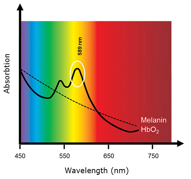 ADVALIGHT - Diode Laser Model ADVATX