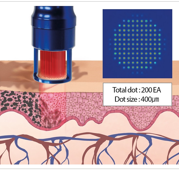 FineMEC - Alexandrite and Nd: YAG Laser Model Nobleen