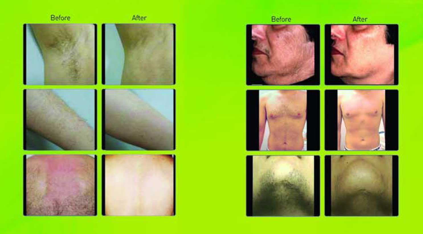 AMT - Olive Laser for Hair Removal