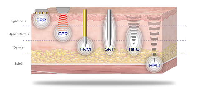 Jeisys - Ultracel  Hifu and RF Contouring Unit