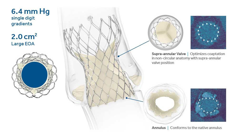 Medtronic - Evolut R System Transcatheter Aortic Valve