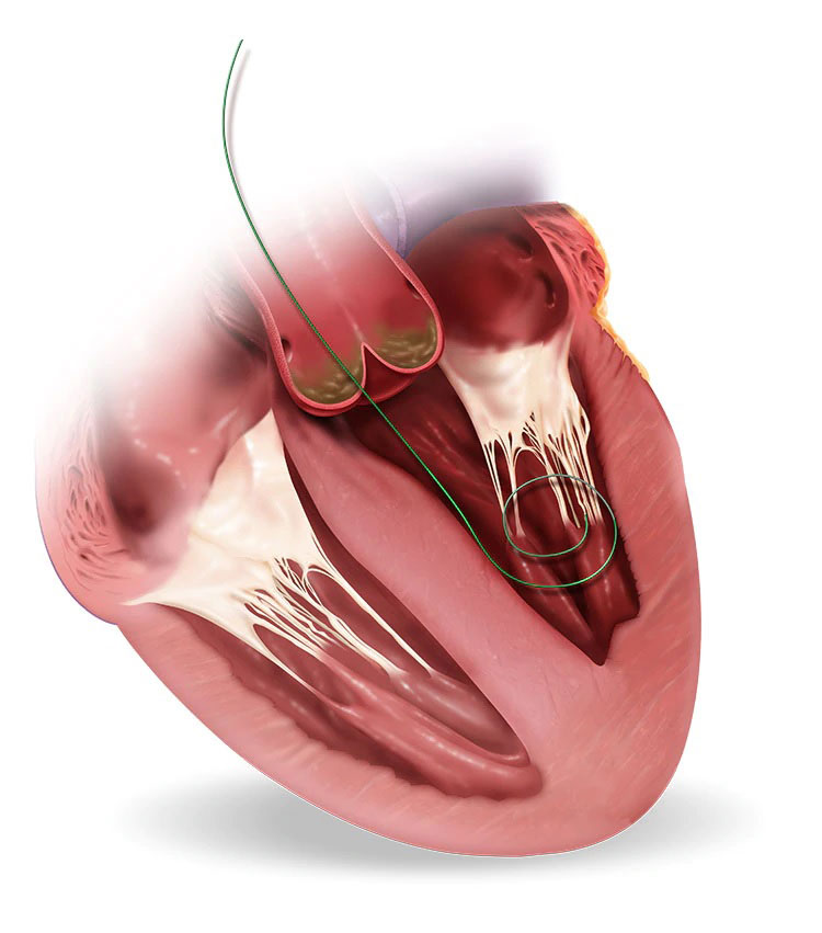 Medtronic - Evolut R System Transcatheter Aortic Valve