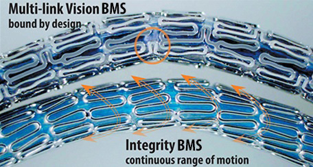 mguard stent inspiremd