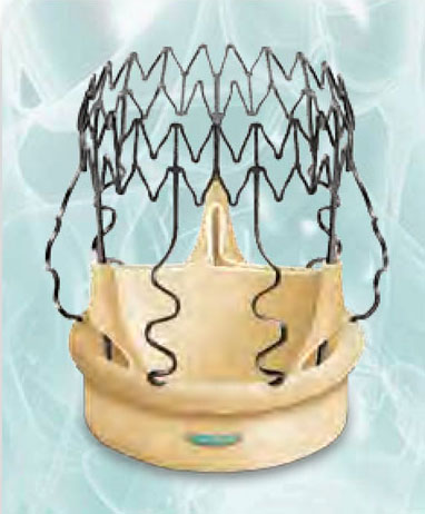 Sorin - Perceval Aortic Heart Valve