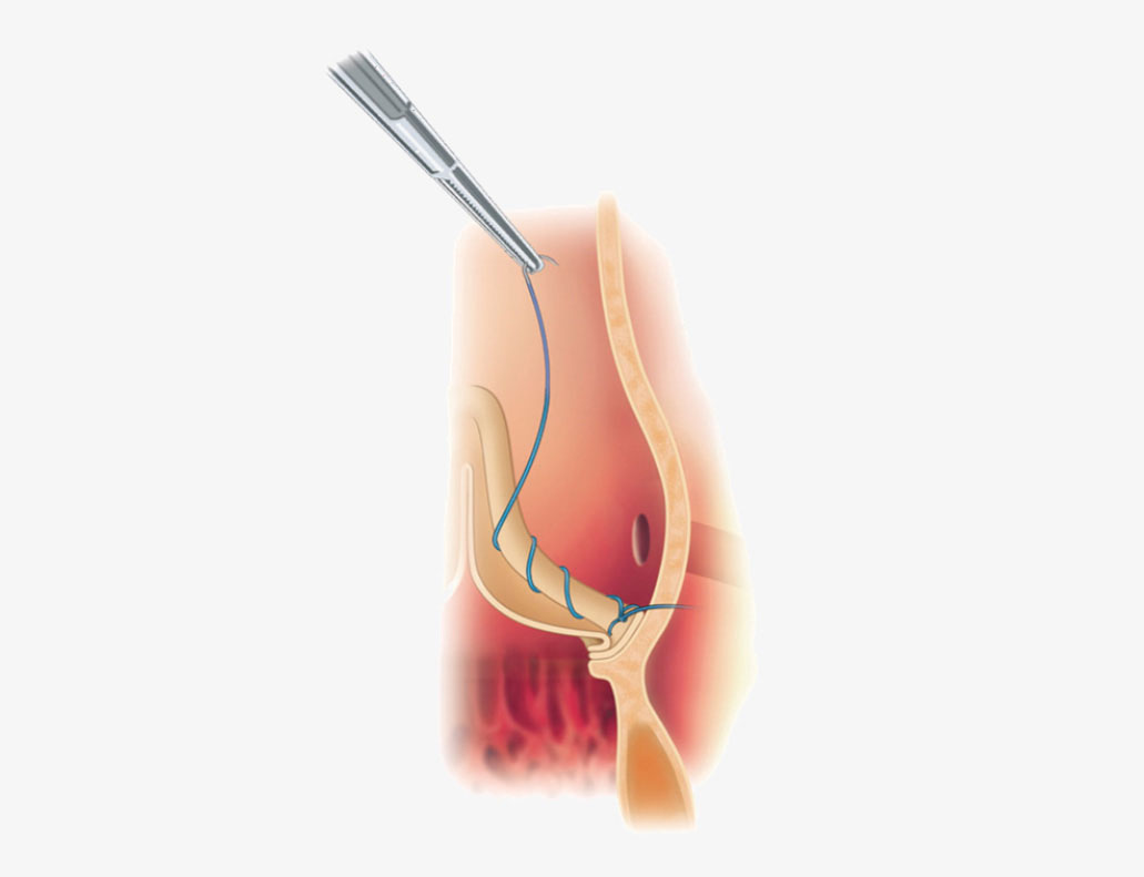 Sorin - Solo Smart Aortic Heart Valve