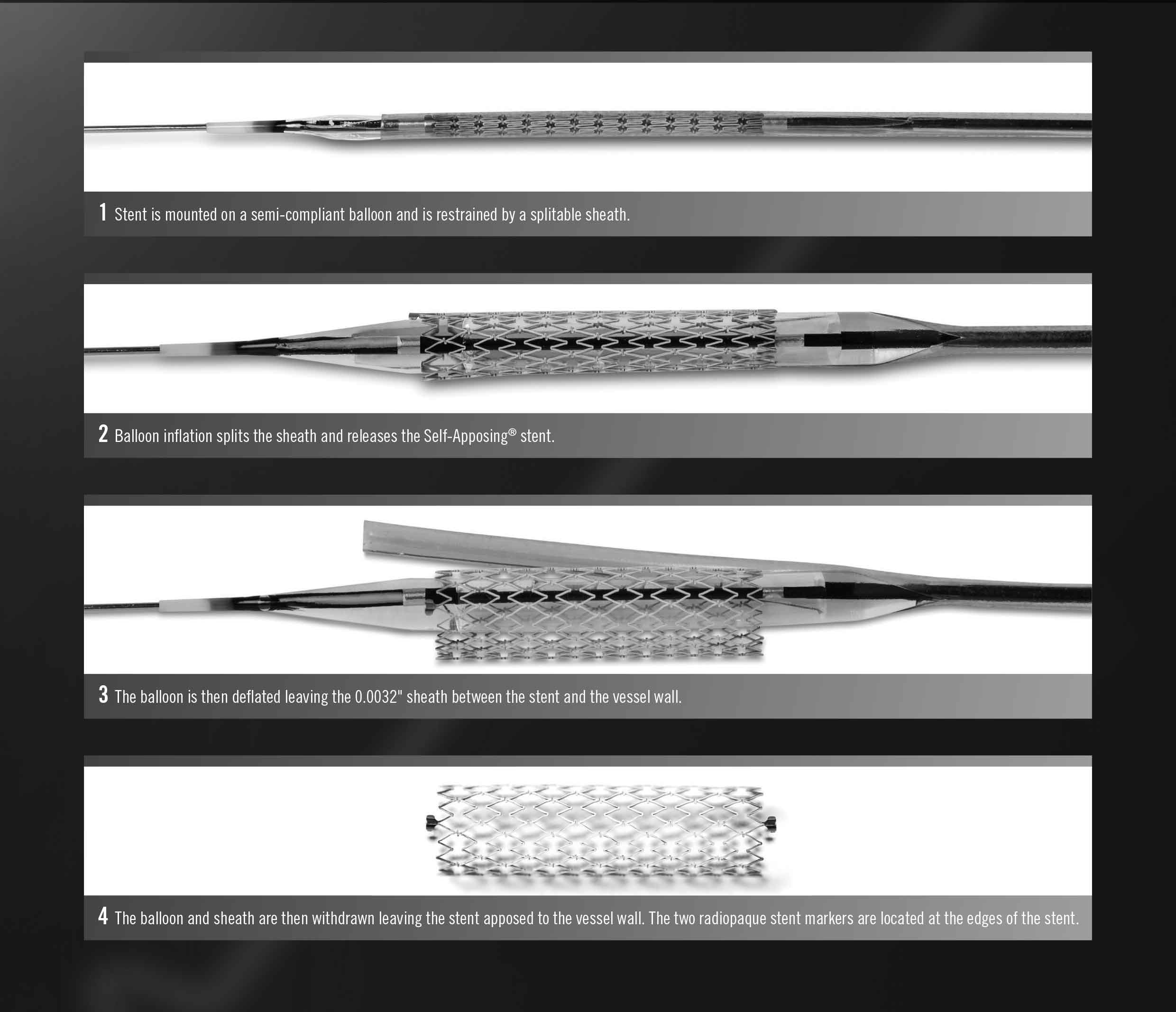 STENTYS S.A - Xposition S Sirolimus-Eluting Self Apposing Coronary Stent