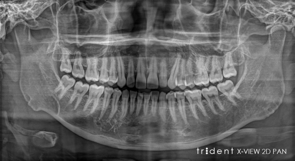 Trident Dental - X-VIEW 2D PAN Panoramic X-ray System - Dandal type V ...