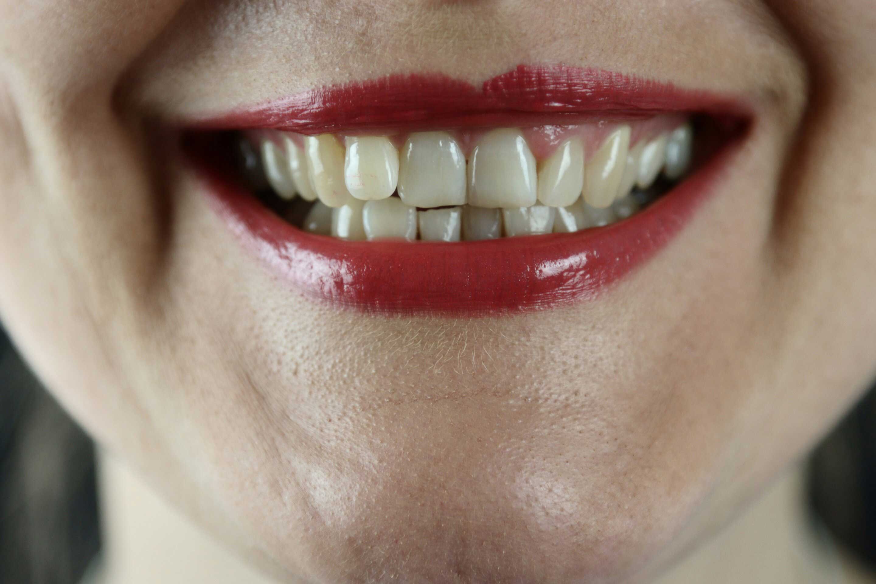 Researches Link Tooth Loss  to Increased Obesity Risk