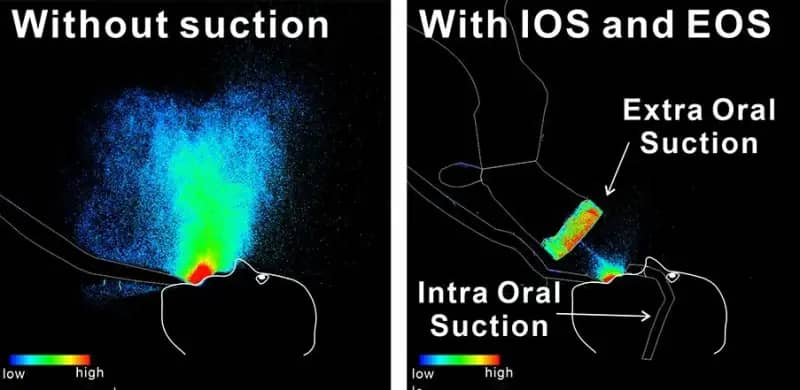 Boosting Dental Safety: The power of Intra-Oral and Extra-Oral Suction Devices