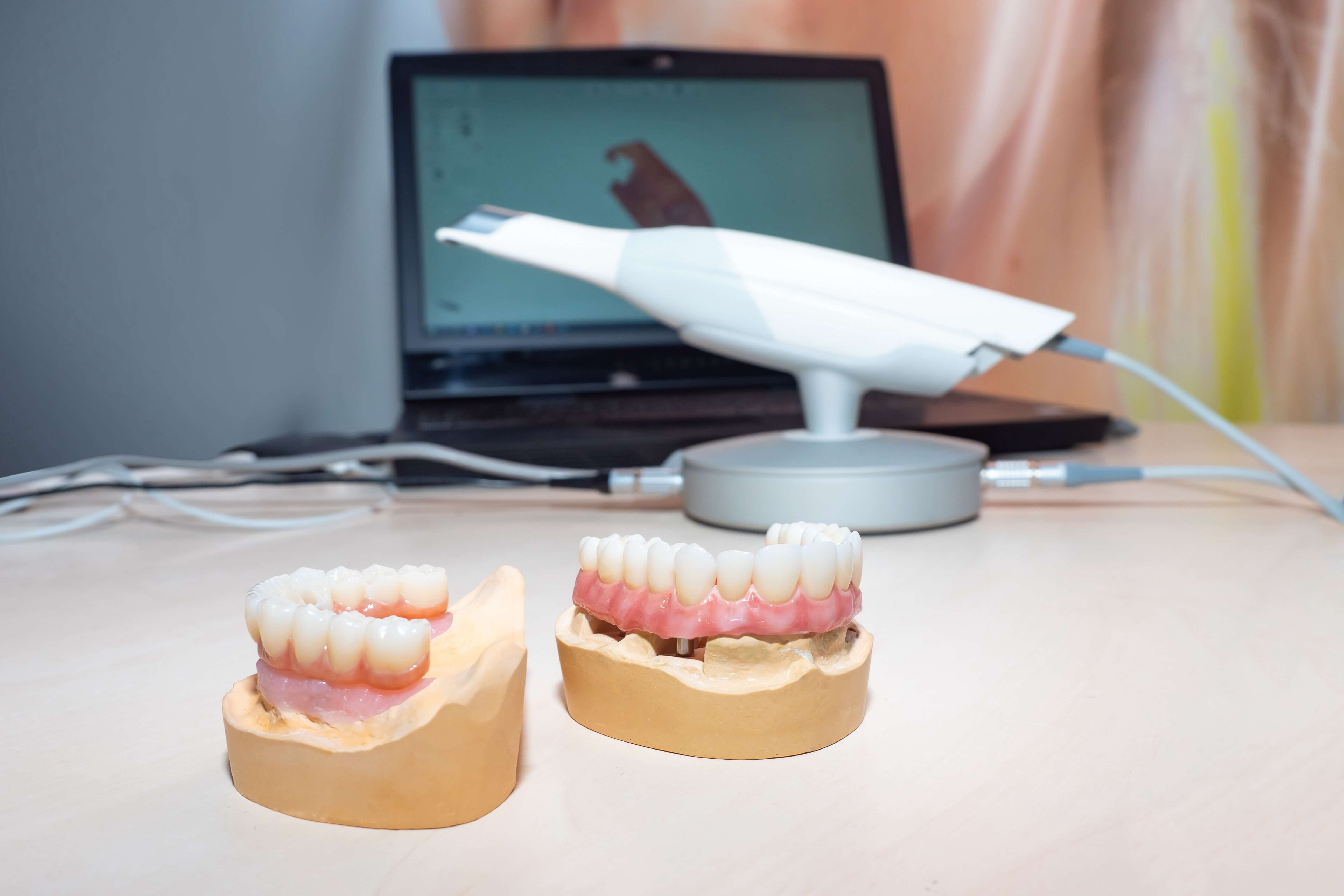 Digital-dentures-with-intraoral-scanner