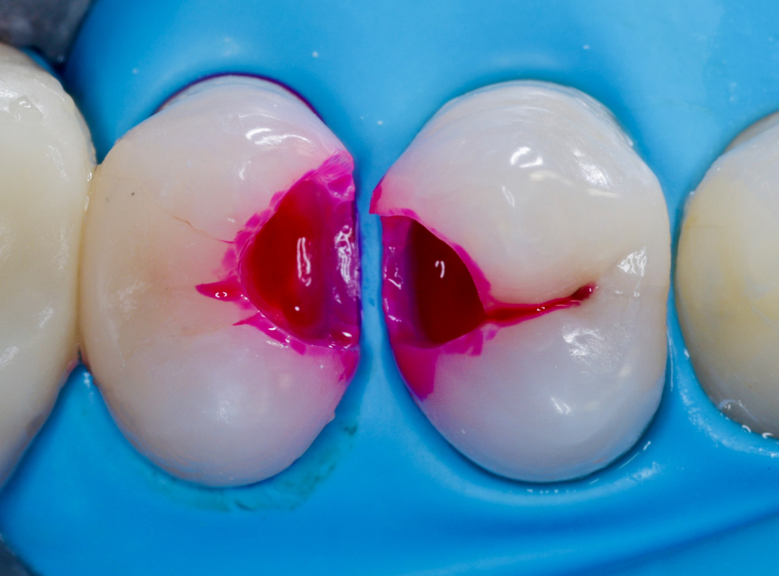 caries detection dyes