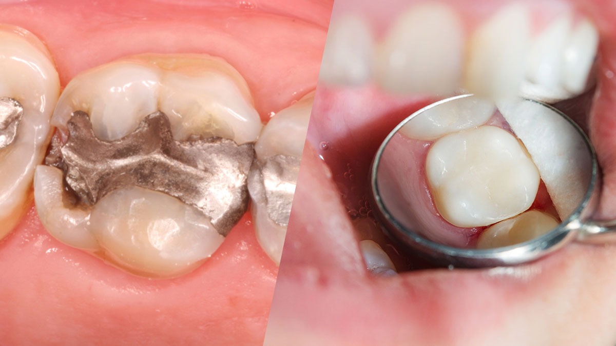 amglam-vs-composite