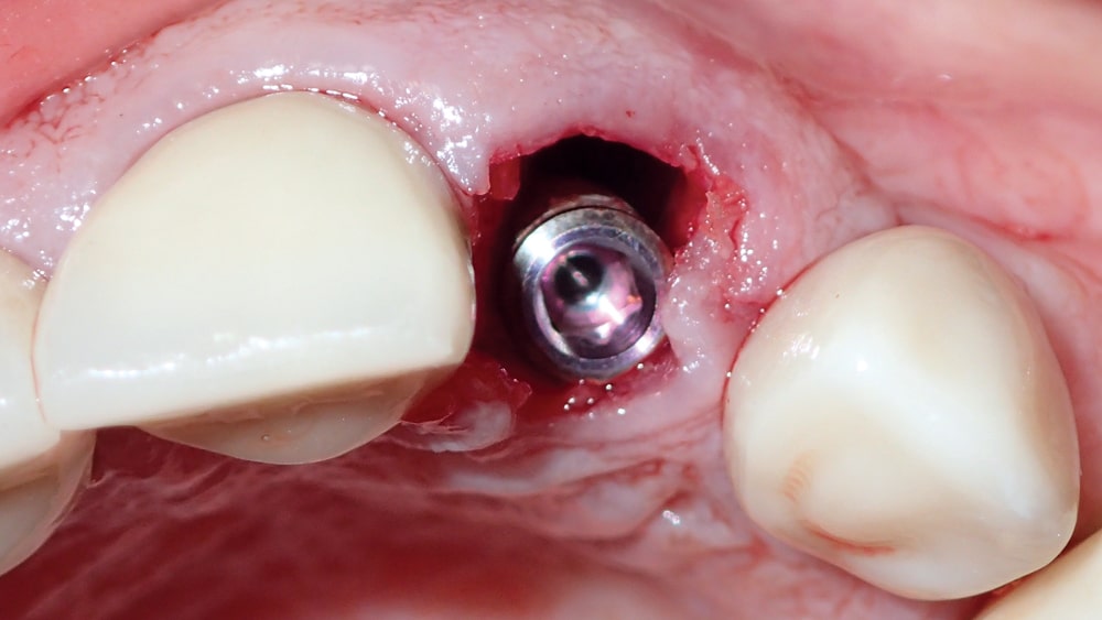 immediate implant placement