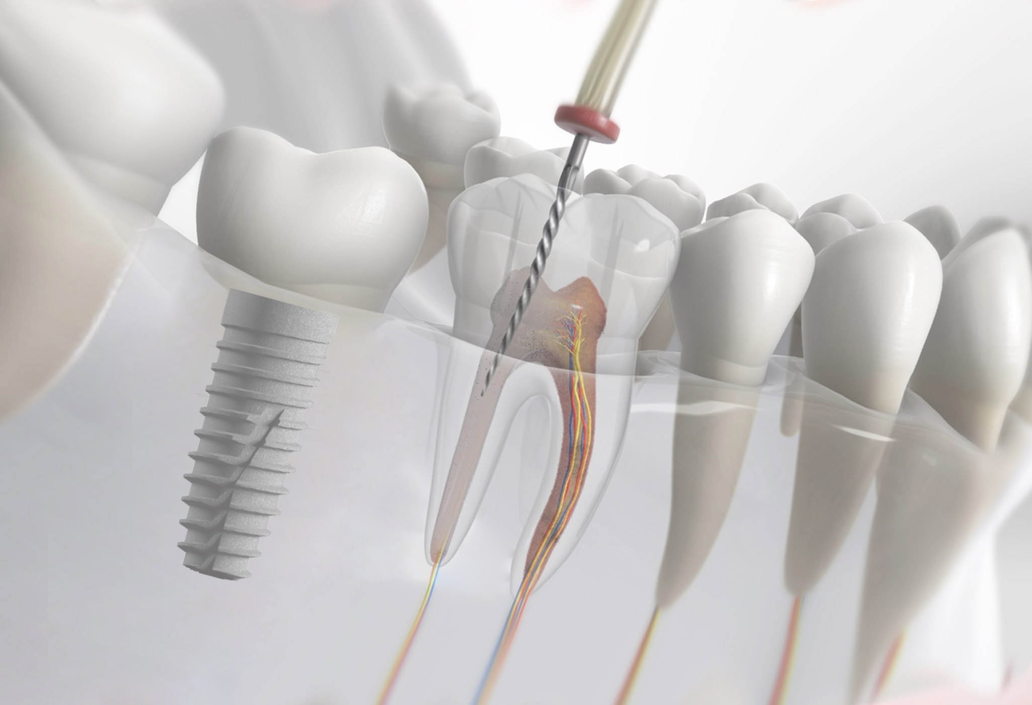 endodontics-versus-implants-treatment-planning-decisions اندو در مقابل ایمپلنت‌ها - انتخاب بهترین روش درمانی