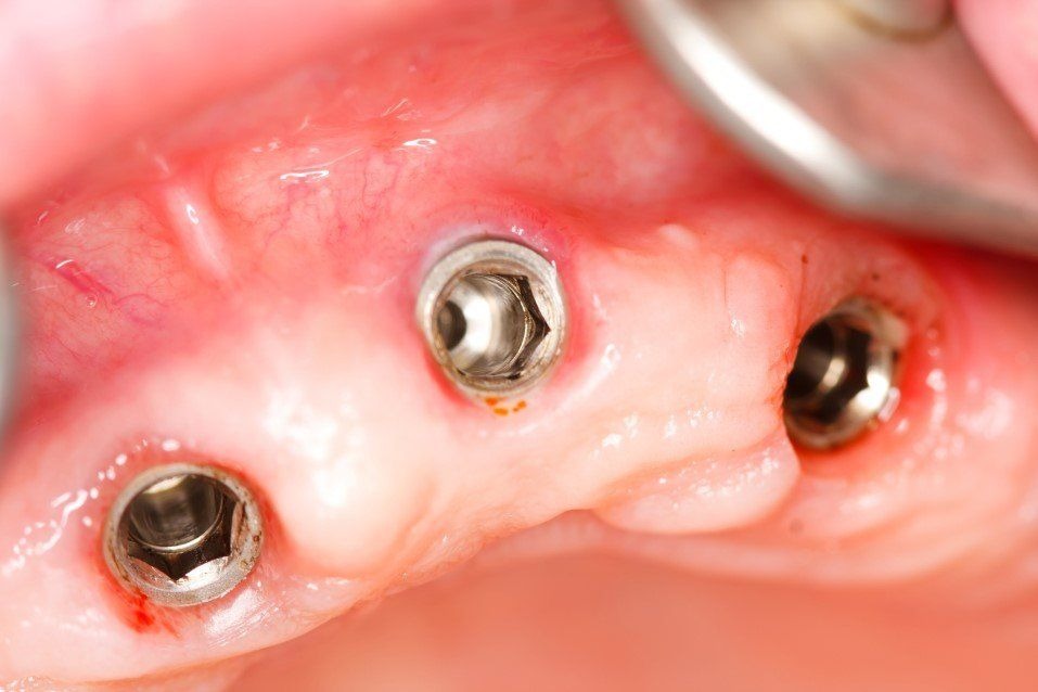 dental implant