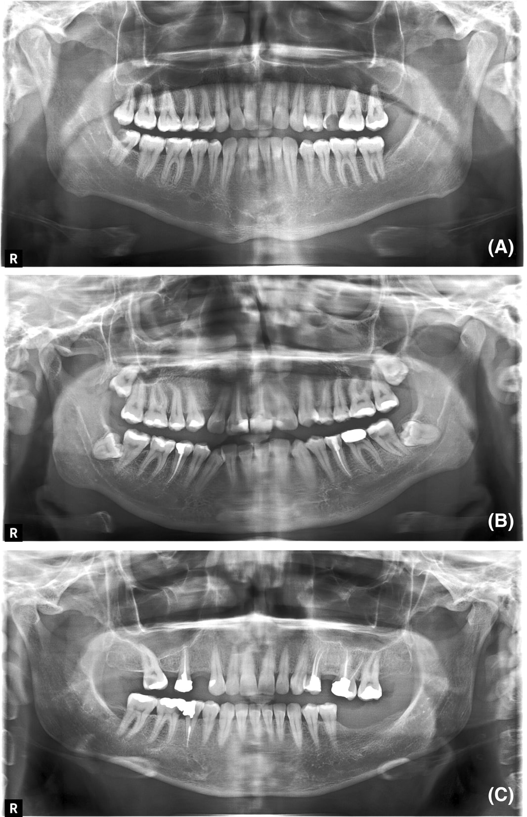 The radiographs were classified as diagnostically acceptable, unacceptable and excellent based on the degree of the palatoglossal air space shadow error