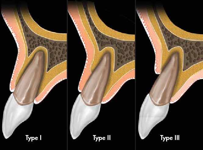 post-extraction sockets types