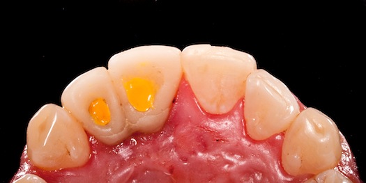 extra-low viscosity PVS impression material to close off a screw access channel in a screw-retained restoration