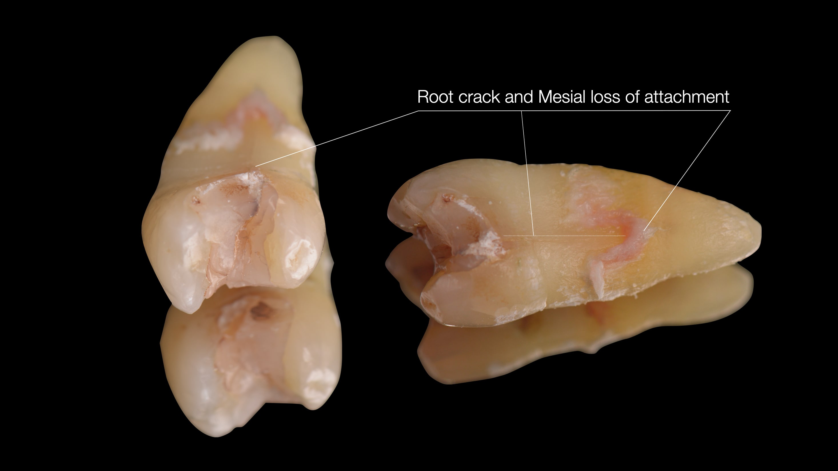 Root crack diagnosis