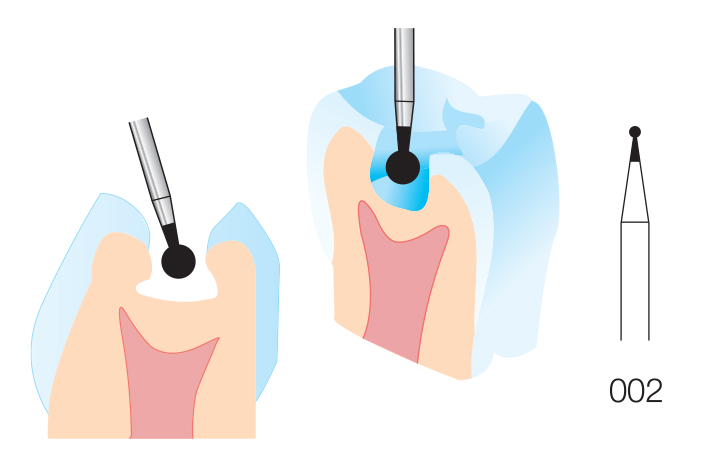 Dental Diamond Burs Round with Collar