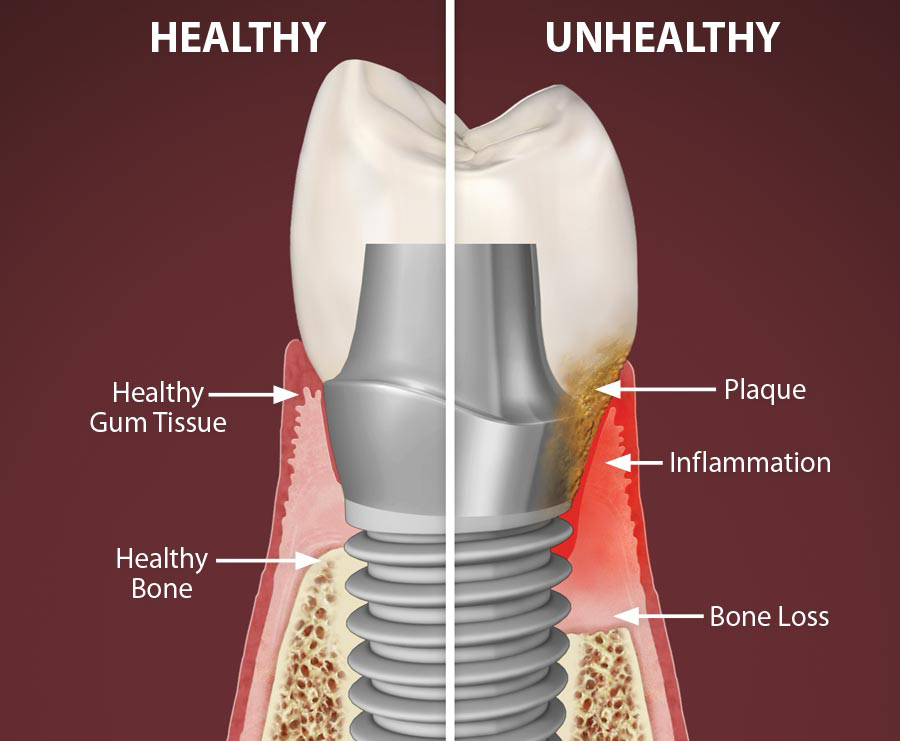 Peri implantitis