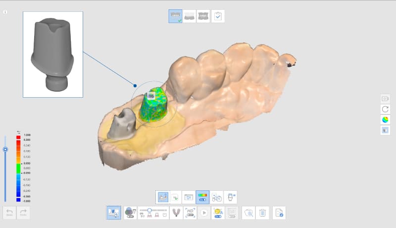 medit-i700-scan-abutment-matching