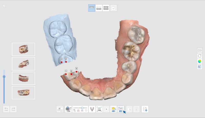 medit-i700-scan-smart-stitching